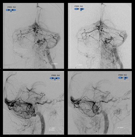 Case Archives Petroclival Meningioma MHT and ILT access | neuroangio.org