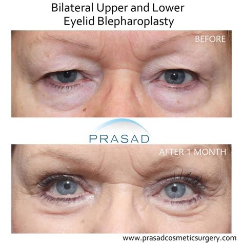 How Hooded Eye Surgery Scars are Minimized | Dr. Prasad Blog