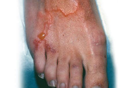 Cutaneous Larva Migrans Symptoms