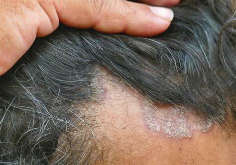 Seborrheic Dermatitis Scalp Hair Loss