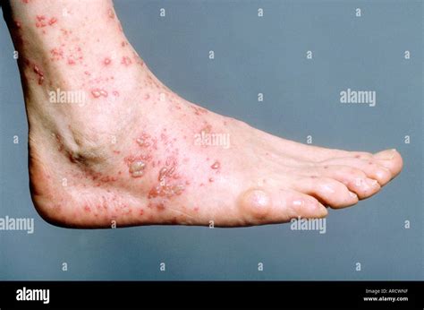 Shingles lesions on foot hi-res stock photography and images - Alamy