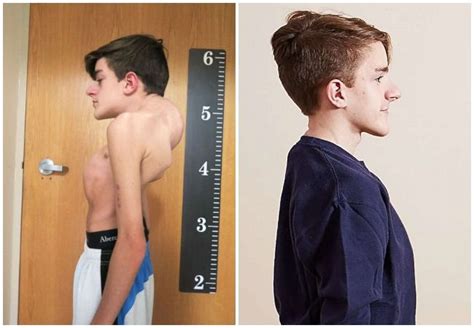 Teenager With Severe Scoliosis Is Transformed After Surgery