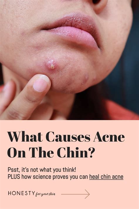 What-Causes-Acne-On-The-Chin_- Honesty For Your Skin