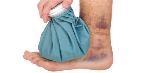 Should You Use Heat or Cold to Treat Your... | Soft tissue injury, Sprained ankle, Sprain