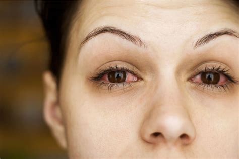 Red Eyes: Causes, Complications, and How to Treat | MyVision.org