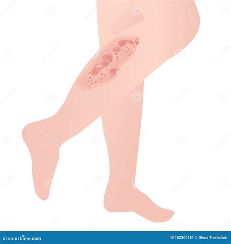 Psoriasis skin disease on stock vector. Illustration of body - 152300181