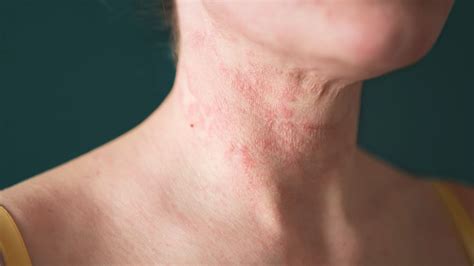 Guide to Effective Eczema Treatment in Singapore