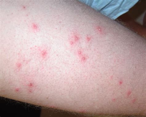 Bacterial Folliculitis Inner Thigh