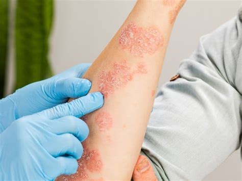 How can you tell if a skin rash is serious? - Westchester Dermatology ...