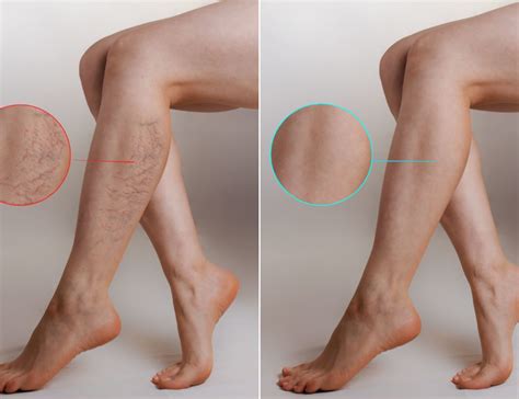 What causes veins to be more visible in legs? - Dr Lawrence Schmetterer