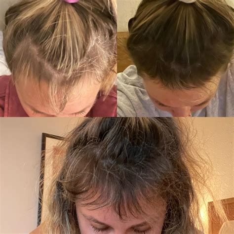 10 month progress on Rogaine : r/FemaleHairLoss