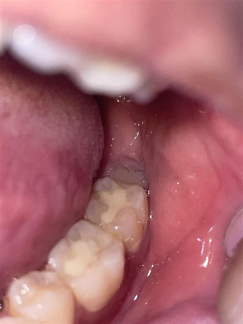 Is this a wisdom teeth pain? : r/wisdomteeth