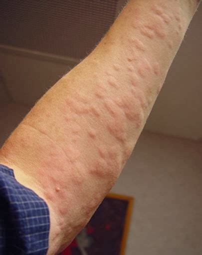 Hives: Characteristic and Causes