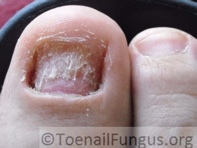 iodine – Toenail Fungus