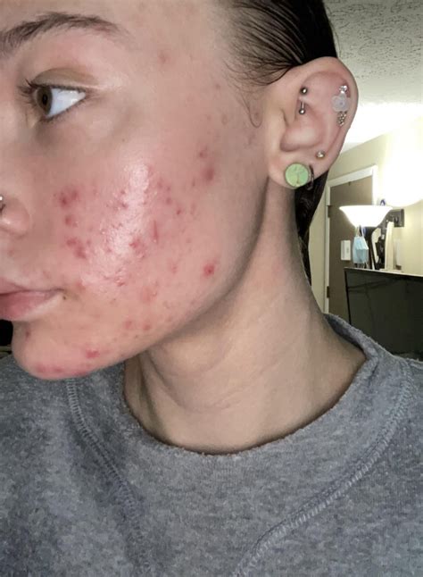 Another Differin gel update! A lot of healing and purging. : r/acne