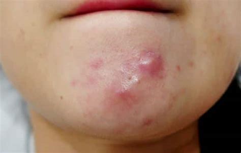 Pimples on Chin Causes, Under Chin Hard Painful, Get Rid of Small Deep Hormonal Chin Acne Treatment