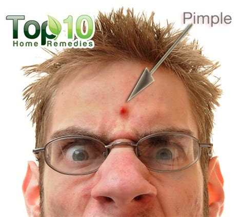 How to Get Rid of Pimples Fast | Medical Treatment