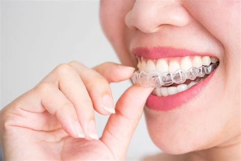 What Are Invisalign Attachments? | Smile Stories