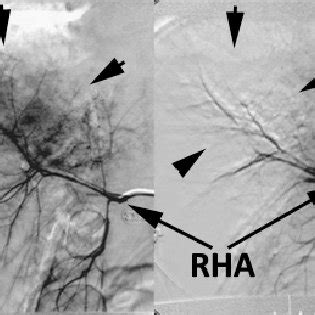 Abdominal CT. Degree IV liver laceration. | Download Scientific Diagram