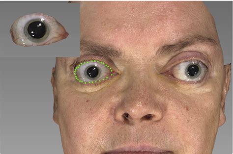 Figure 1 from Three-dimensional changes of scleral show after surgical treatment of endocrine ...