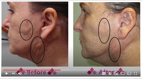 Fibrosis to Face After a Face Lift : Aspen Facelift Treatment for Lumpy Knots - YouTube