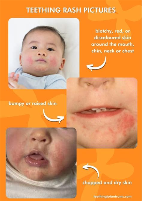 Teething Rash: Causes, Symptoms, Pictures, 7 Top Treatments