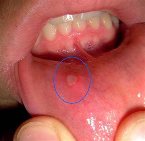 Mouth sores. Causes, symptoms, treatment Mouth sores