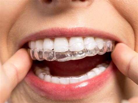 How are Invisalign attachments removed?