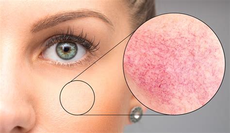 A detailed look into Rosacea Skin Conditions – Skin Nerd Australia