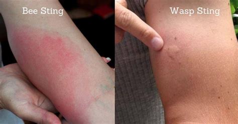 Bee Sting Vs Wasp Sting: Which is dangerous? – Beesstyle