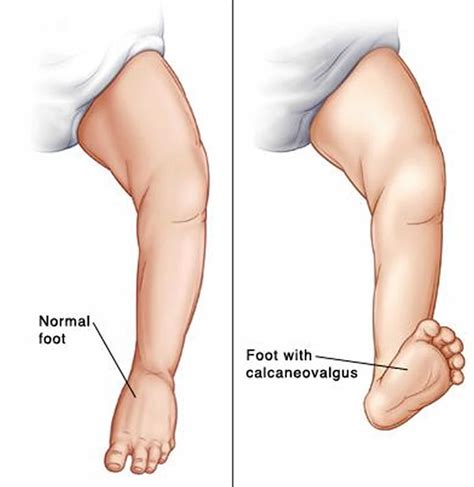 Calcaneovalgus foot causes, symptoms, diagnosis & treatment