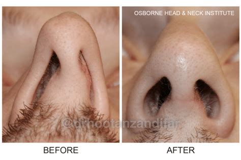 Deviated septum repair and rhinoplasty - Zandifar MD