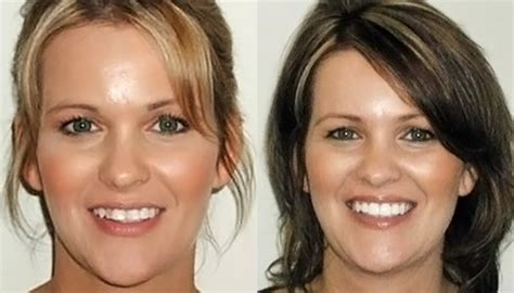 Invisalign® Before & After - Orthodontist Wareham MA | Coastal Orthodontics | Orthodontist Wareham