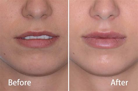 Juvederm In Lips Before And After Photos | Lipstutorial.org