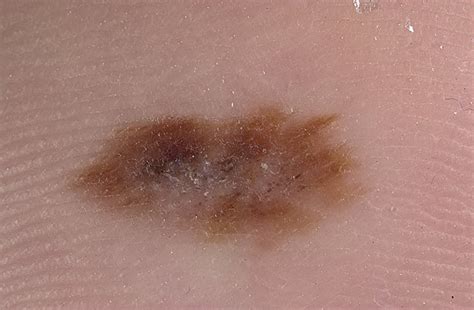 Melanoma on Leg Pictures – 16 Photos & Images / illnessee.com