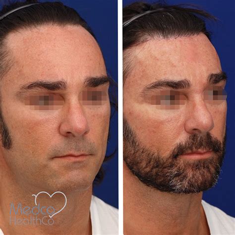 Forehead Reduction Surgery | Medco Healthco | Stay Safe and Healthy