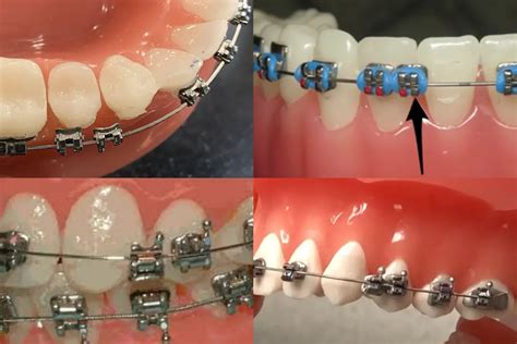 Broken Bracket On Braces? The 3 Things You NEED To Do