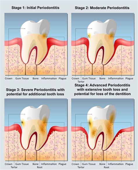 Periodontal Disease - Portland Perio Implant Center