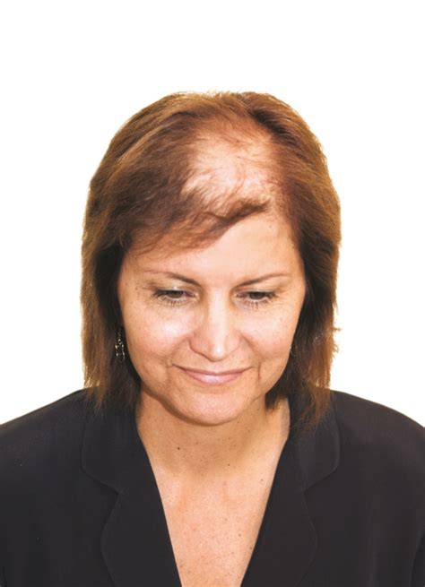 What to Do About Lupus Hair Loss • Southwest Florida's Health and Wellness Magazine