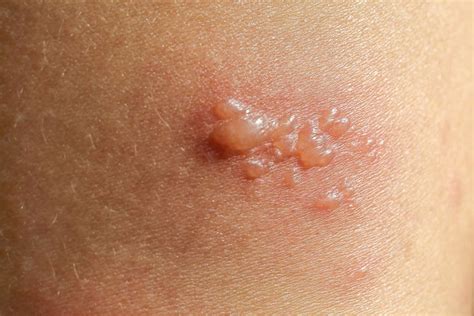 Skin Lesions: Pictures, Types, Causes, Treatment