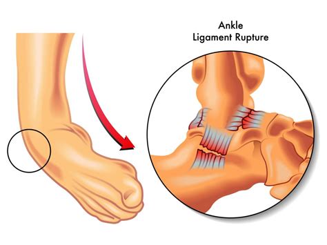 Ankle - Orthopaedic Center of the Virginias