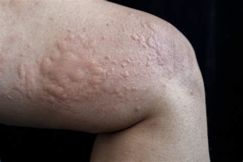 Hives (urticaria): Causes, Pictures, Treatments, And, 53% OFF