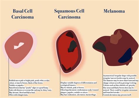 Melanoma Skin Cancer Types