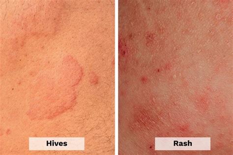 Hives Causes Symptoms Diagnosis Treatment And Prevention – NBKomputer