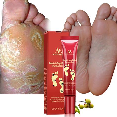 Herbal Foot Treatment Anti Fungal Infection Onychomycosis Paronychia Effective Toe Fungus ...