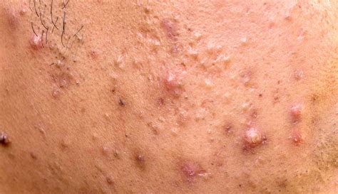 Acne Papules: vs. Pustules & Symptoms, Causes & Treatment