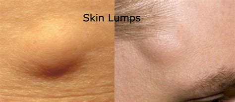 Skin Lump Surgery Singapore - Lipoma Removal Procedure