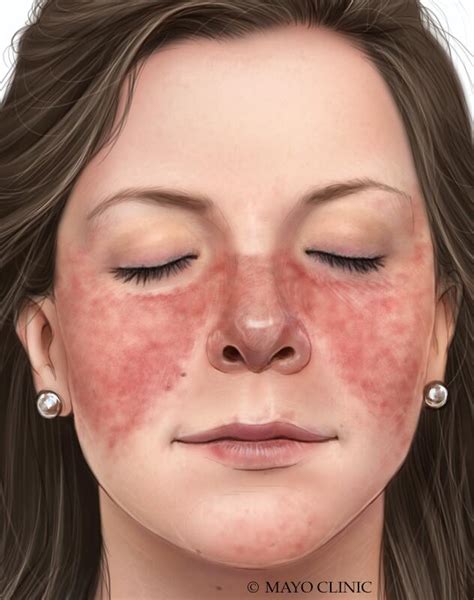 Lupus - Symptoms & causes - Mayo Clinic