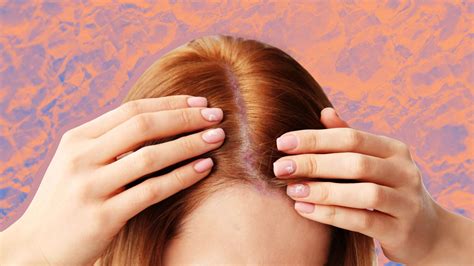 Scalp Psoriasis: Treatment Options