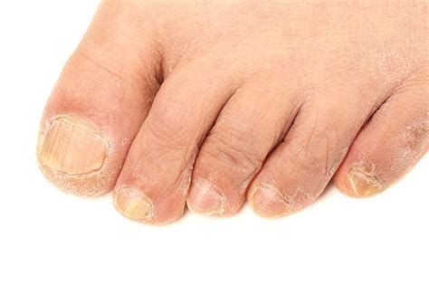 dmso and toenail fungus - Toenail Fungus Treatment | Toenail Fungus Treatment